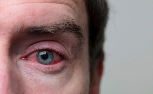 Jak pozbyć się czerwonych oczu?