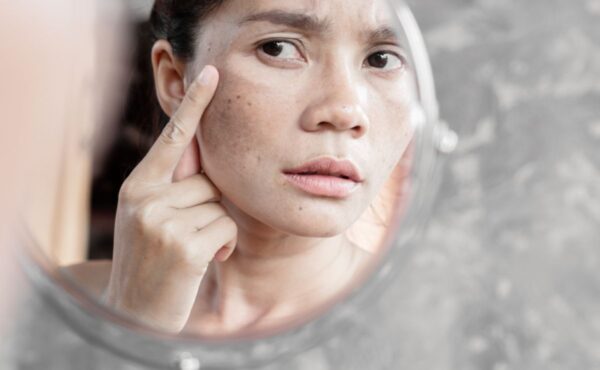 Jak znaleźć najlepszy krem na przebarwienia i odzyskać promienną skórę