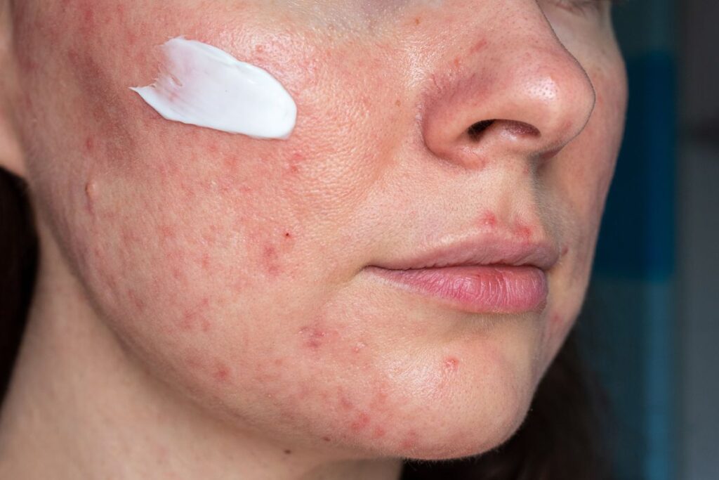 Jakie kosmetyki na trądzik różowaty naprawdę działają? Odkryj sprawdzone rozwiązania