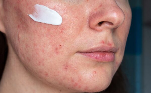 Jakie kosmetyki na trądzik różowaty naprawdę działają? Odkryj sprawdzone rozwiązania