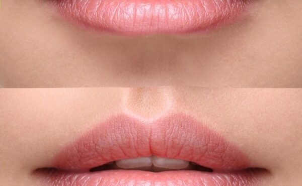 To warto wiedzieć: 7 błędów przy powiększaniu ust