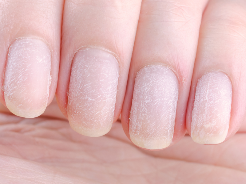 Jak wygląda uszkodzona macierz paznokcia