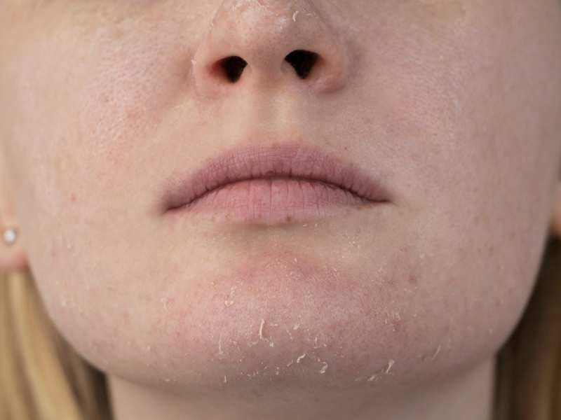 Czy oczyszczanie twarzy może być szkodliwe? I to jak!