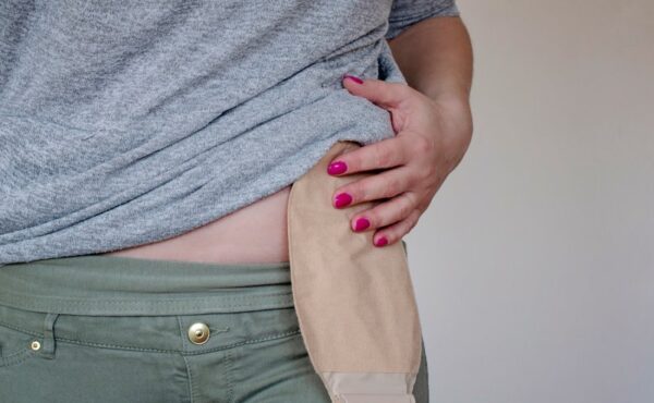 Co to jest ileostomia?
