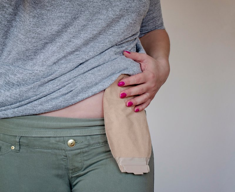 Co to jest ileostomia?