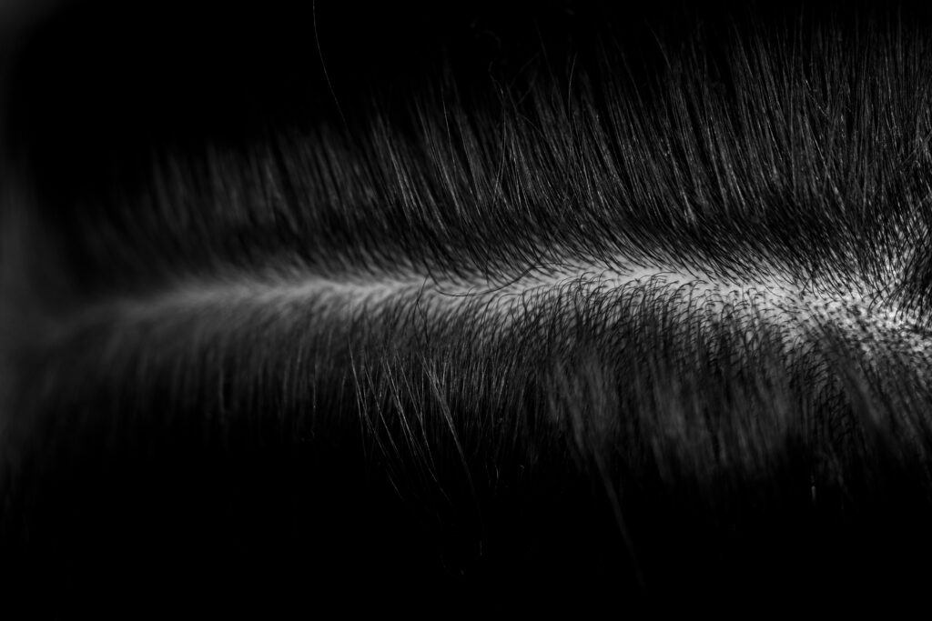 Mikropigmentacja skóry głowy – nowoczesne rozwiązanie dla osób z problemem łysienia