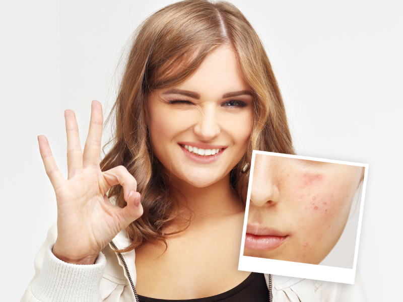 Domowe sposoby na trądzik