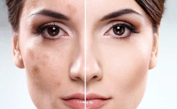 Kosmetyki na trądzik różowaty, które nie zniszczą Twojej cery